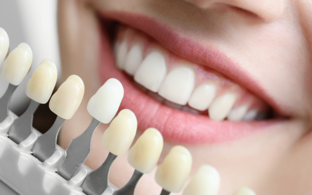 Can Professional Teeth Whitening Remove Those Stubborn Deep Stains?