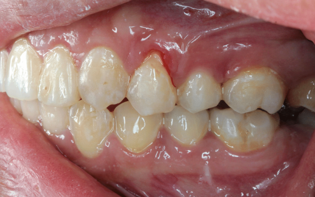 Why Do My Gums Keep Bleeding? Understanding the Real Causes Behind Persistent Bleeding