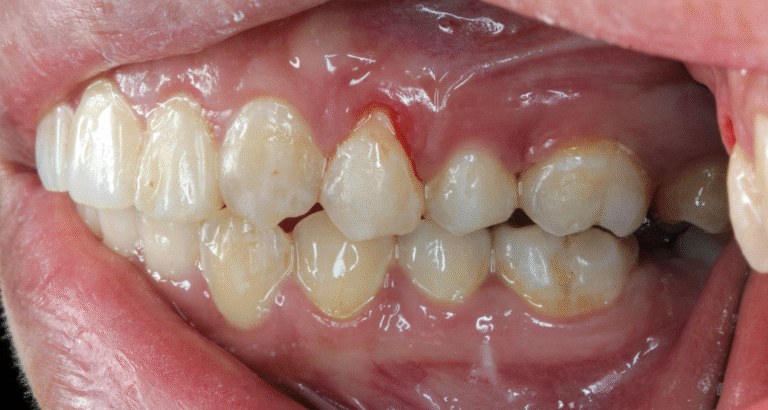 Persistent Bleeding Gums Causes Melbourne | DENTL Treatment