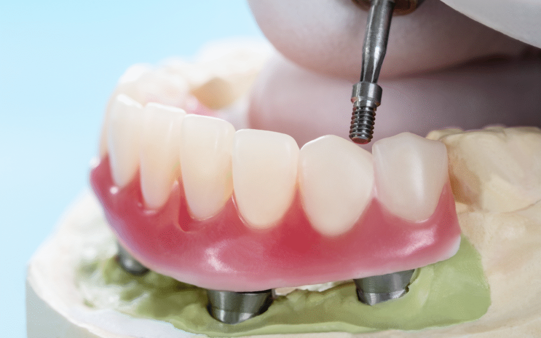 Can All-Teeth-On-4 Work with Significant Bone Loss? What You Need to Know