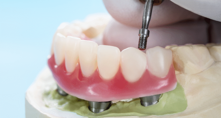 All-Teeth-On-4 Bone Loss Treatment Melbourne | DENTL