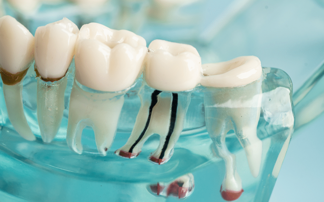 Root Canal vs Tooth Extraction: When Should You Save Your Natural Tooth?
