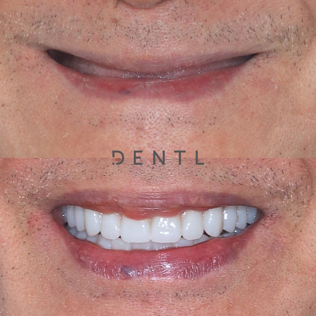 C's All-on-Four In Dentl