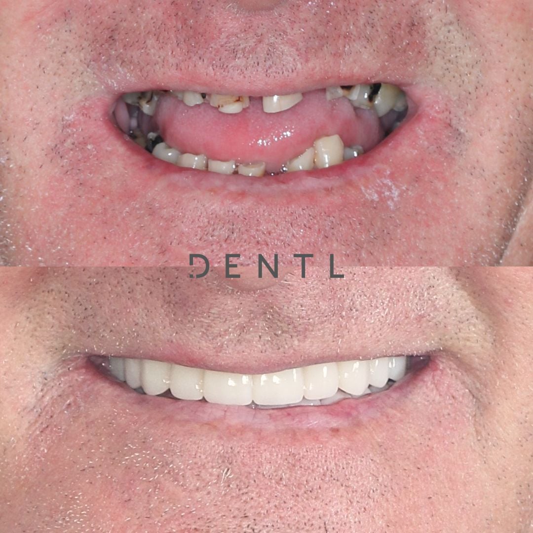 G's All-on-Four In Dentl
