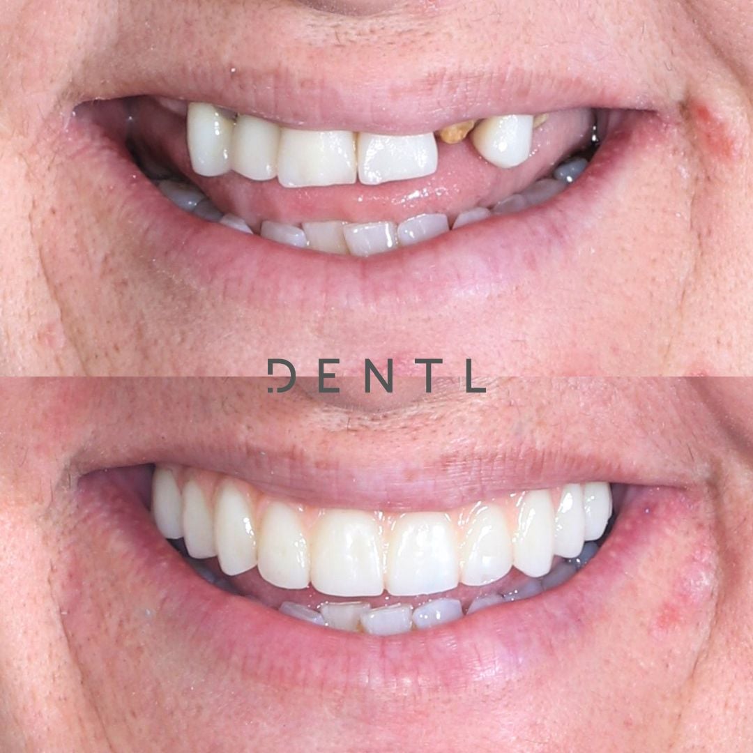 J's All-on-Four In Dentl