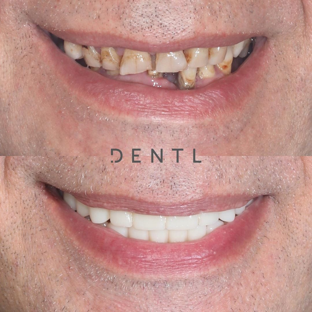 L's All-on-Four In Dentl
