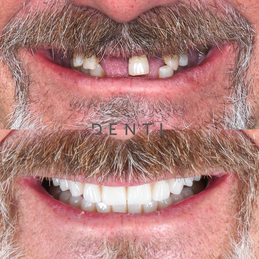 P's All-on-Four In Dentl