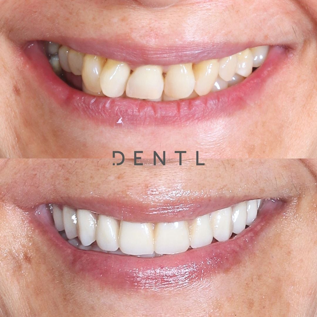 R's All-on-Four In Dentl