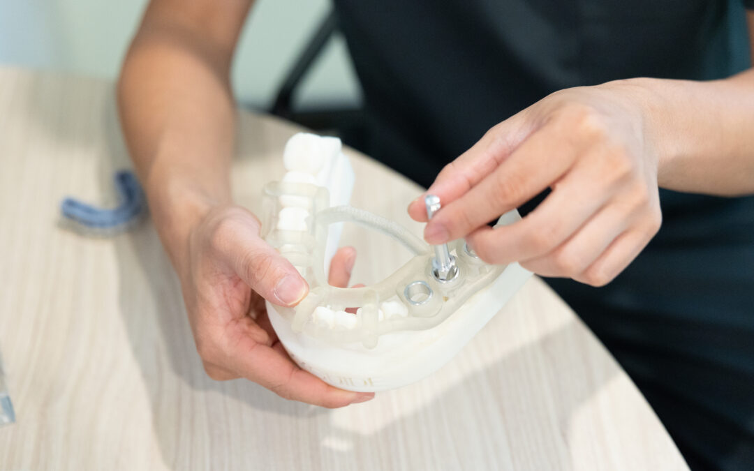 Understanding Recovery Times for Dental Implants